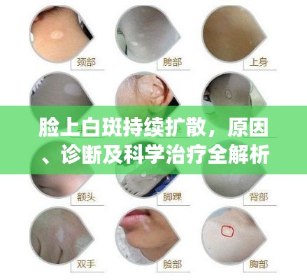 脸上白斑持续扩散,原因、诊断及科学治疗全解析
